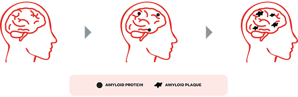 Three side-profile illustrations of a human brain show the progression from normal to amyloid protein buildup to advanced amyloid plaque accumulation, with a legend explaining the symbols.